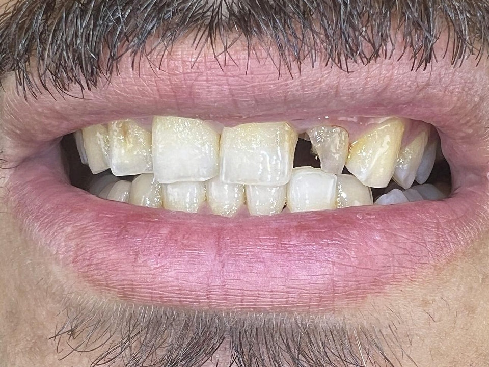 قبل — ترميم سن أمامي